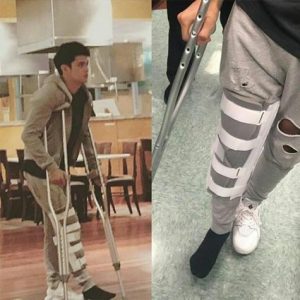 Closer look of the right leg of James Reid after the  accident.